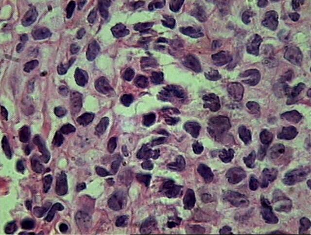 Fig.3 Atipia linfoide severa - <div style=